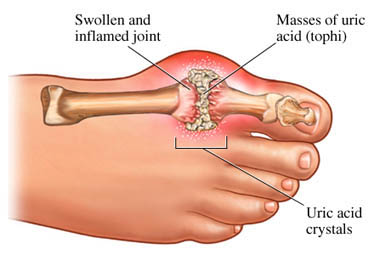 gout uva