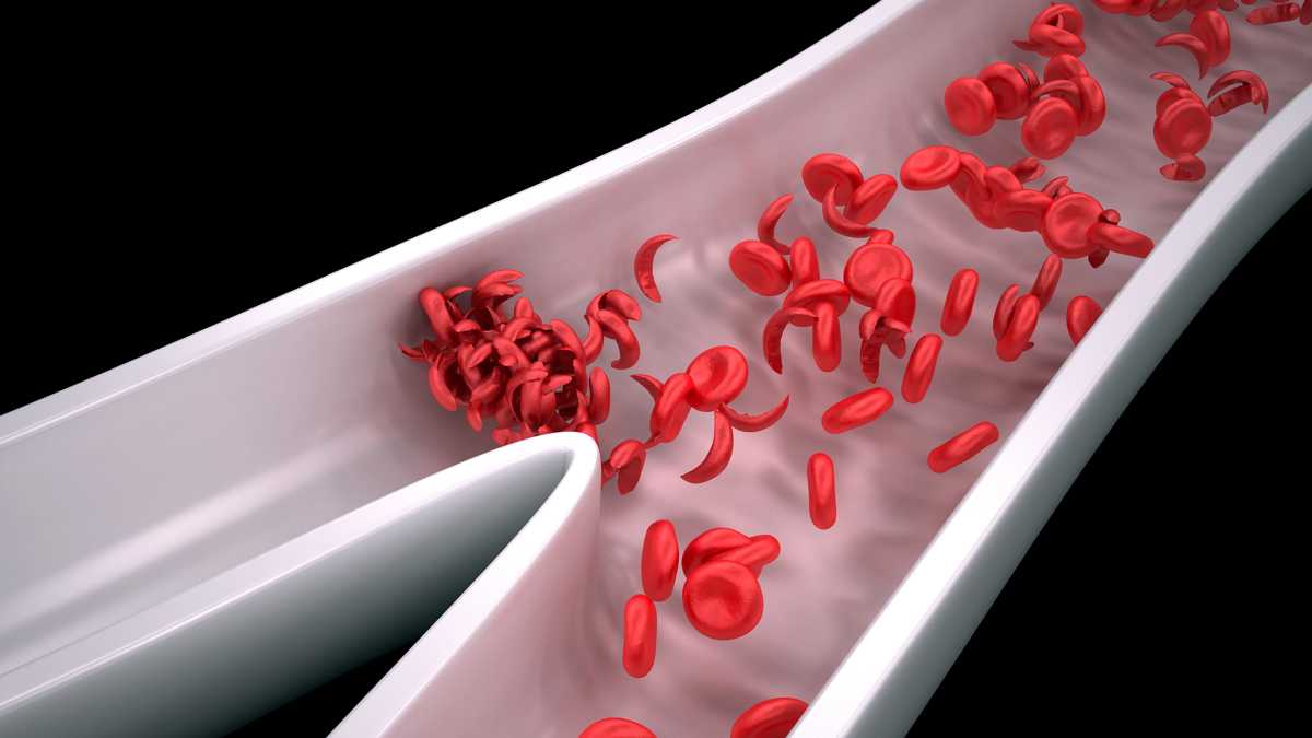 sickle-cell blockage