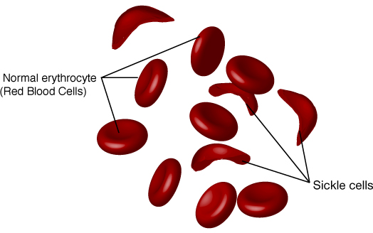 sickle_cell_disease_sm