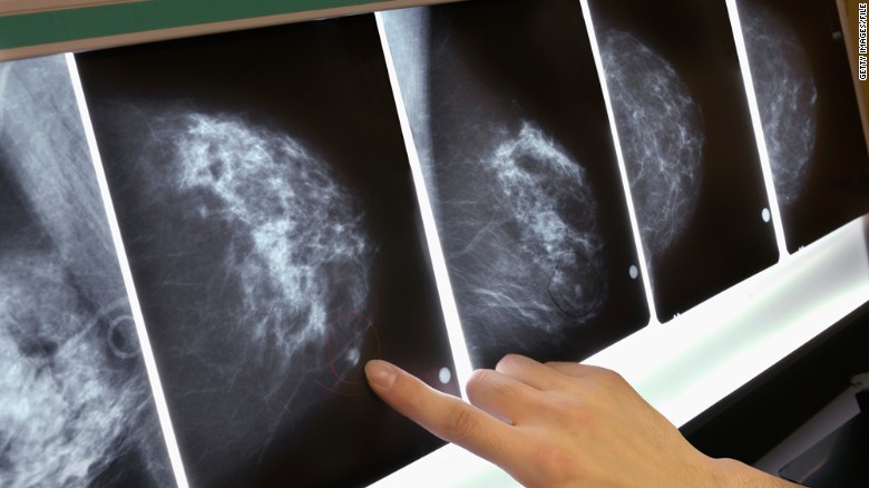 mammogram-breast-cancer-x-ray-exlarge-169