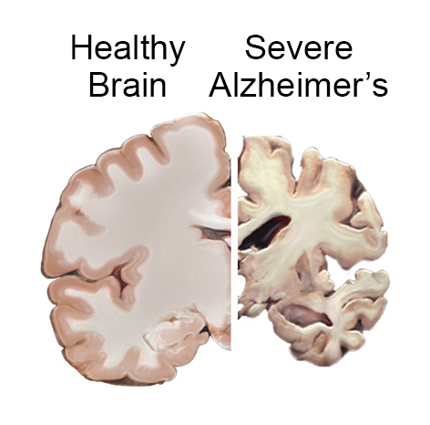 alzheimers brain_slices