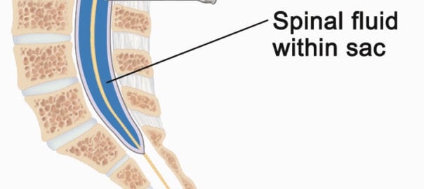 what-is-a-spinal-tap-and-why-is-it-done-jeffrey-sterling-md