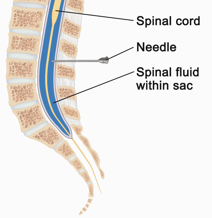 spinaltap