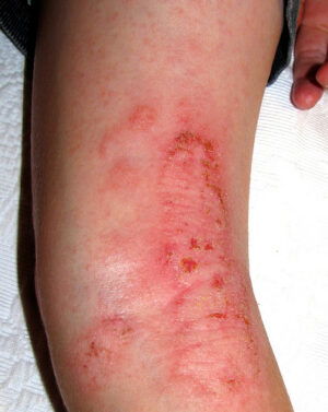 diaper rash Archives - Jeffrey Sterling, MD